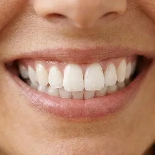 ICON Behandlung Saarland weiße Flecken auf Zahn