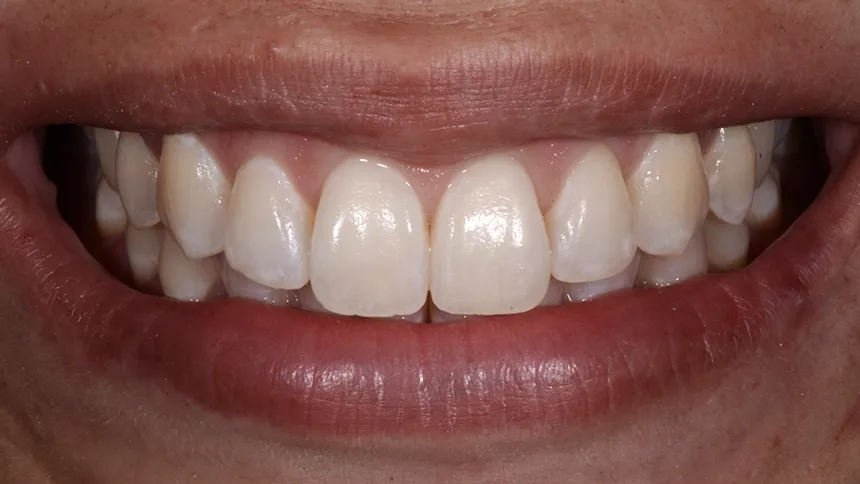 ICON Behandlung Zahnarzt Dillingen Vorher