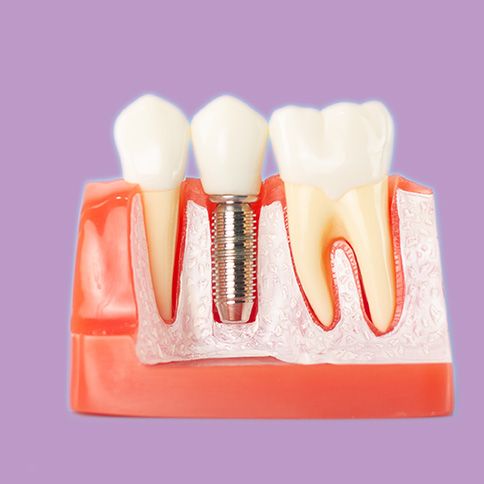 Zahn Implantat